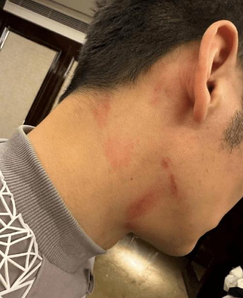 免费资料-资料大全和脖子被扎多根烧烤签与被烧烤签子扎出血了